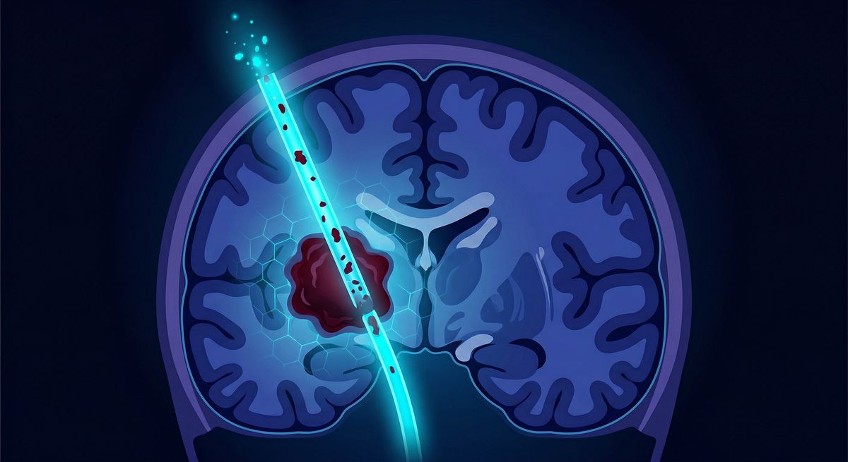 Cirurgia Minimamente Invasiva para AVC Hemorrágico: O Estudo ENRICH e a Nova Era